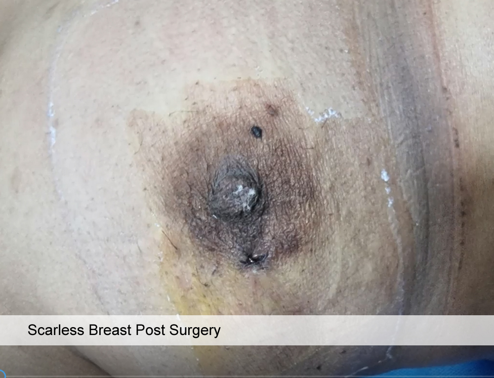 Scarless Removal of Breast Lump, Dr. Amit Agarwal