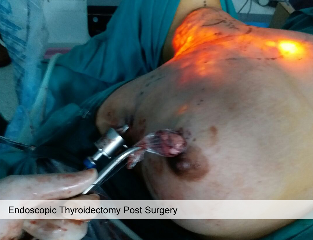 Scarless Thyroid Surgery Dr Sudhi Agarwal Kamboj