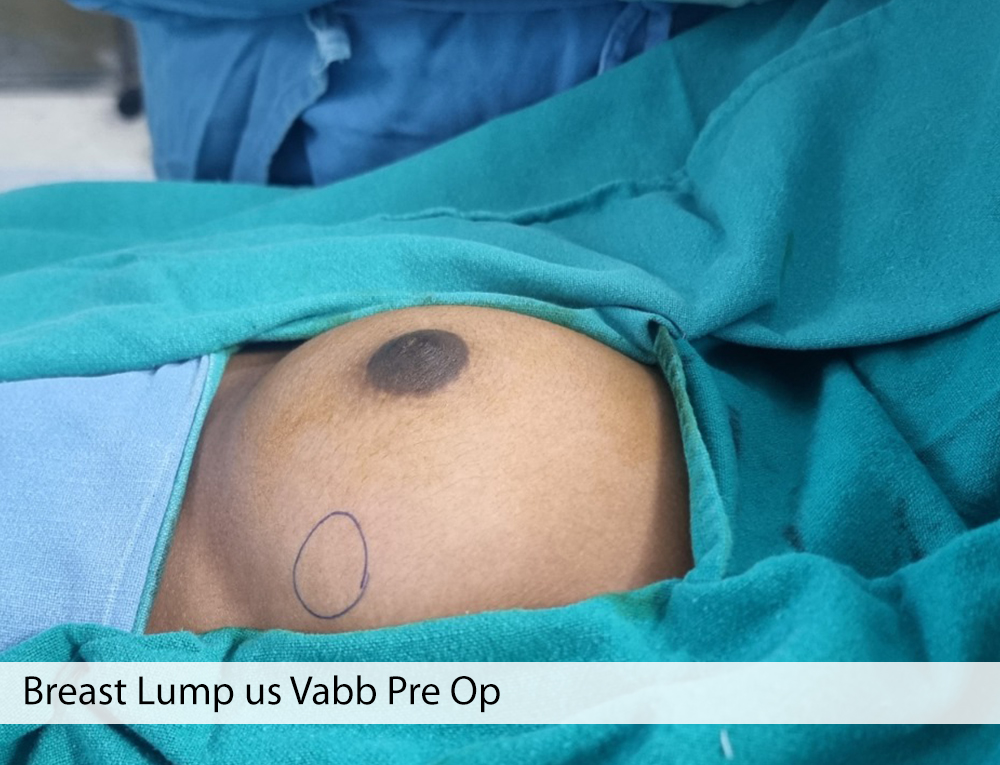 Scarless Removal of Breast Lump, Dr. Amit Agarwal