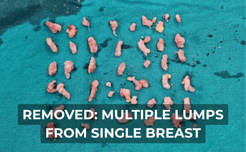 Scarless Breast Lumps Excision (2)