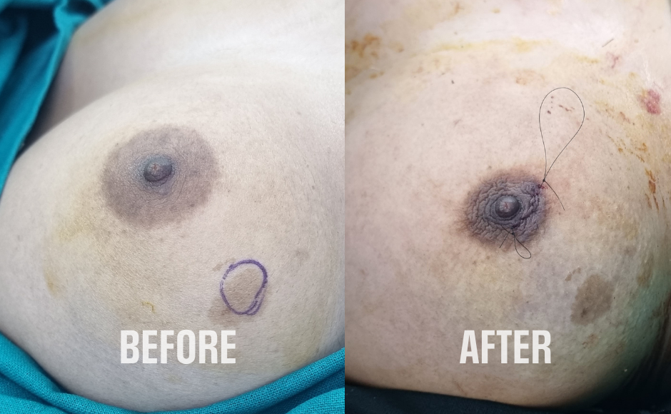 Scarless Breast Lumps Excision (3)