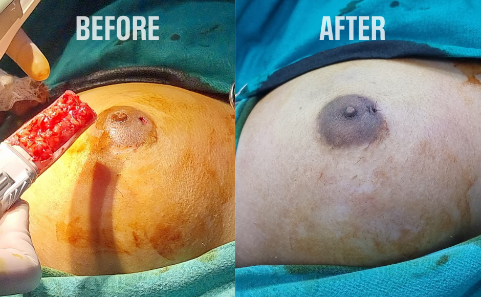 Scarless Breast Lumps Excision
