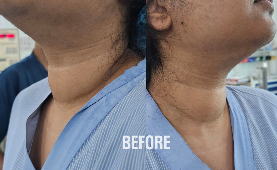 Thyroid Nodules & Cancers (2)