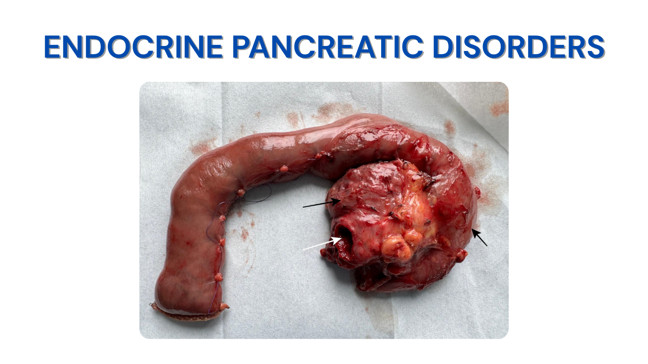 Endocrine Pancreatic Disorders