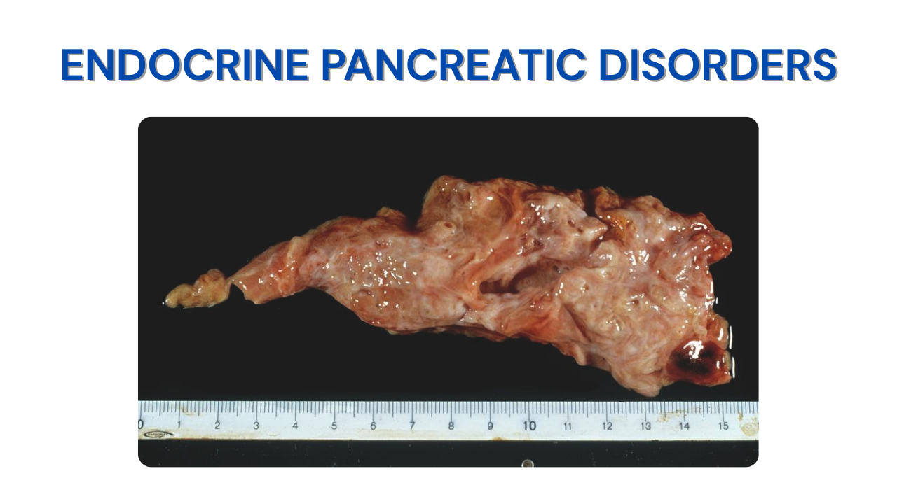 Endocrine Pancreatic Disorders (3)