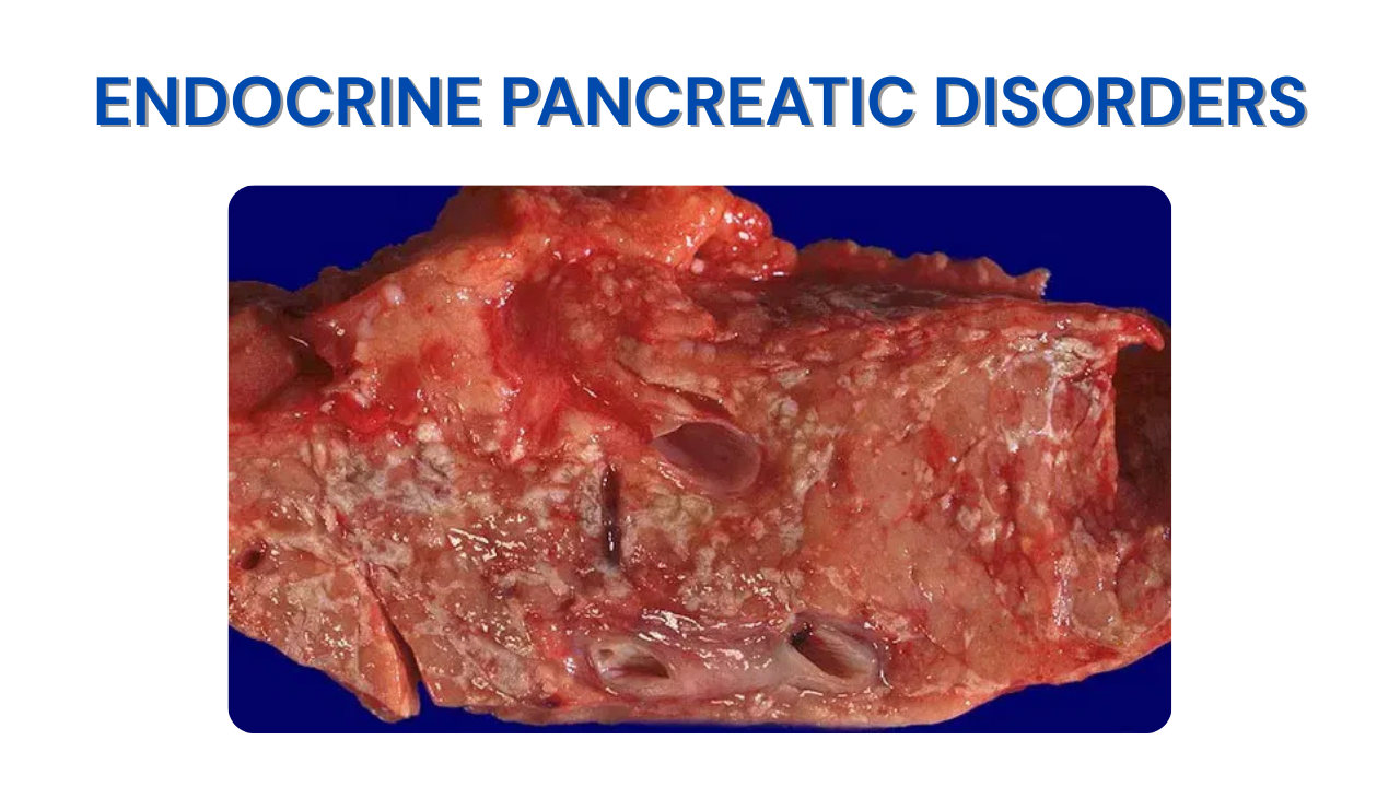 Endocrine Pancreatic Disorders