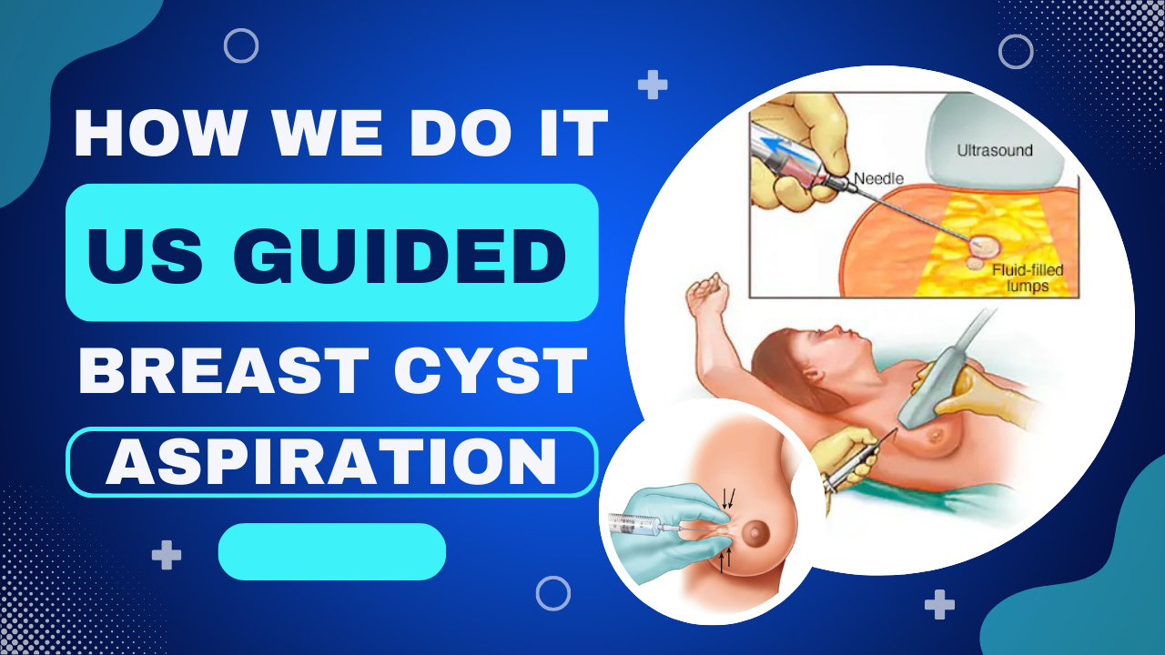 HOW WE DO IT - US GUIDED BREAST CYST ASPIRATION