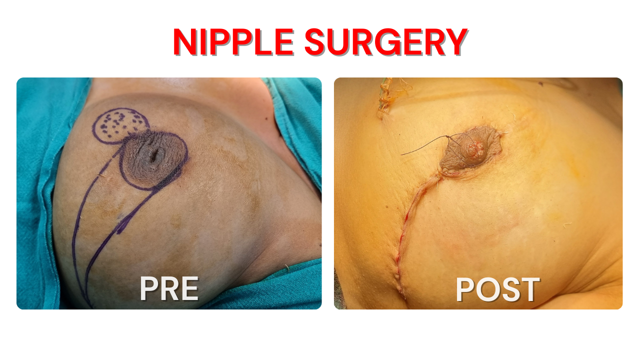 Nipple Surgery