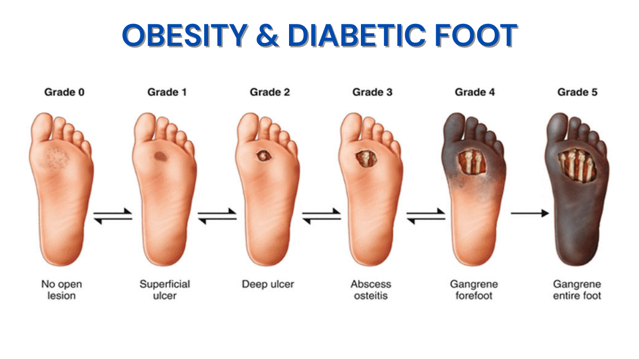 Obesity & Diabetic Foot (2)
