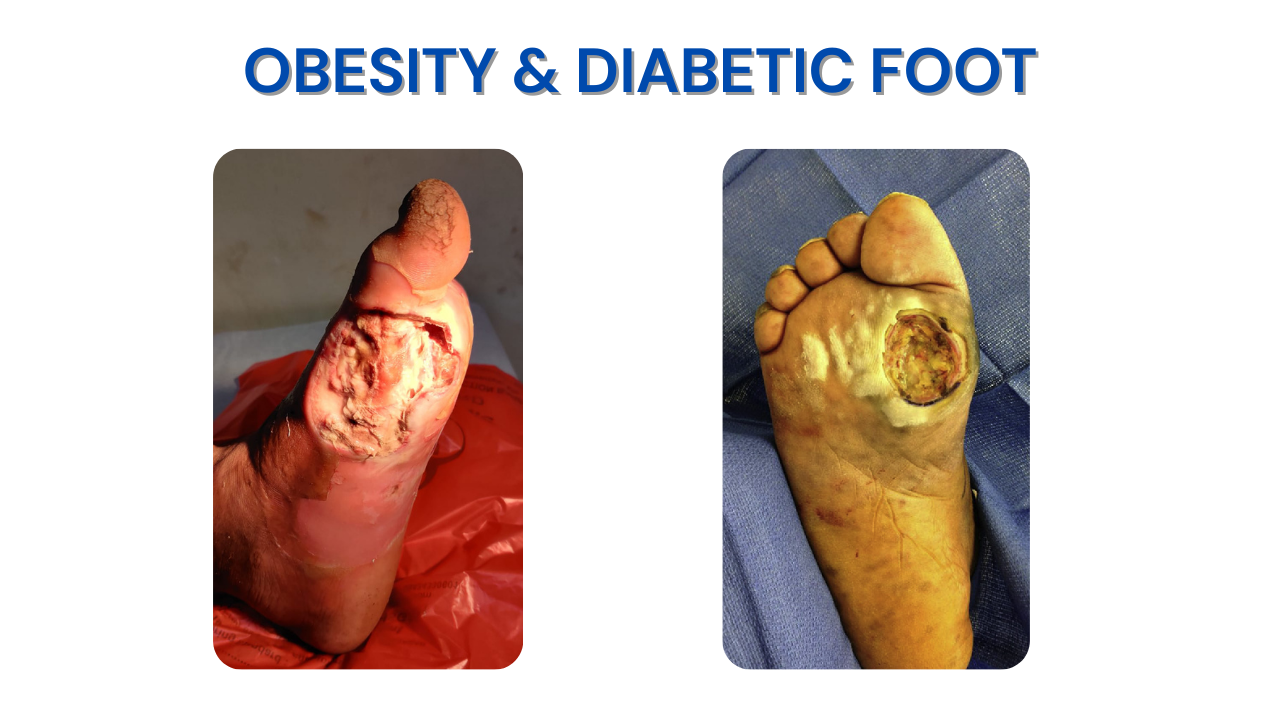 Obesity & Diabetic Foot (3)