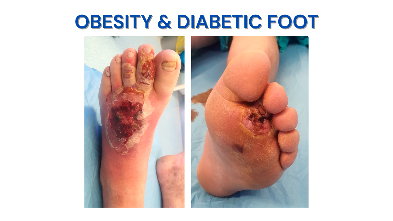 Obesity & Diabetic Foot (4)