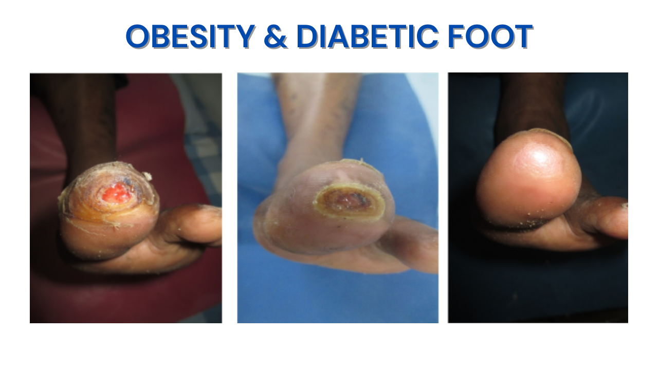 Obesity & Diabetic Foot
