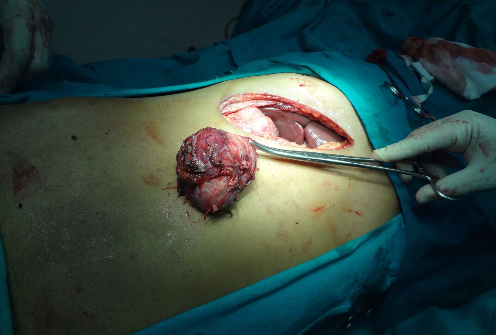 adrenal tumor for gallary 2