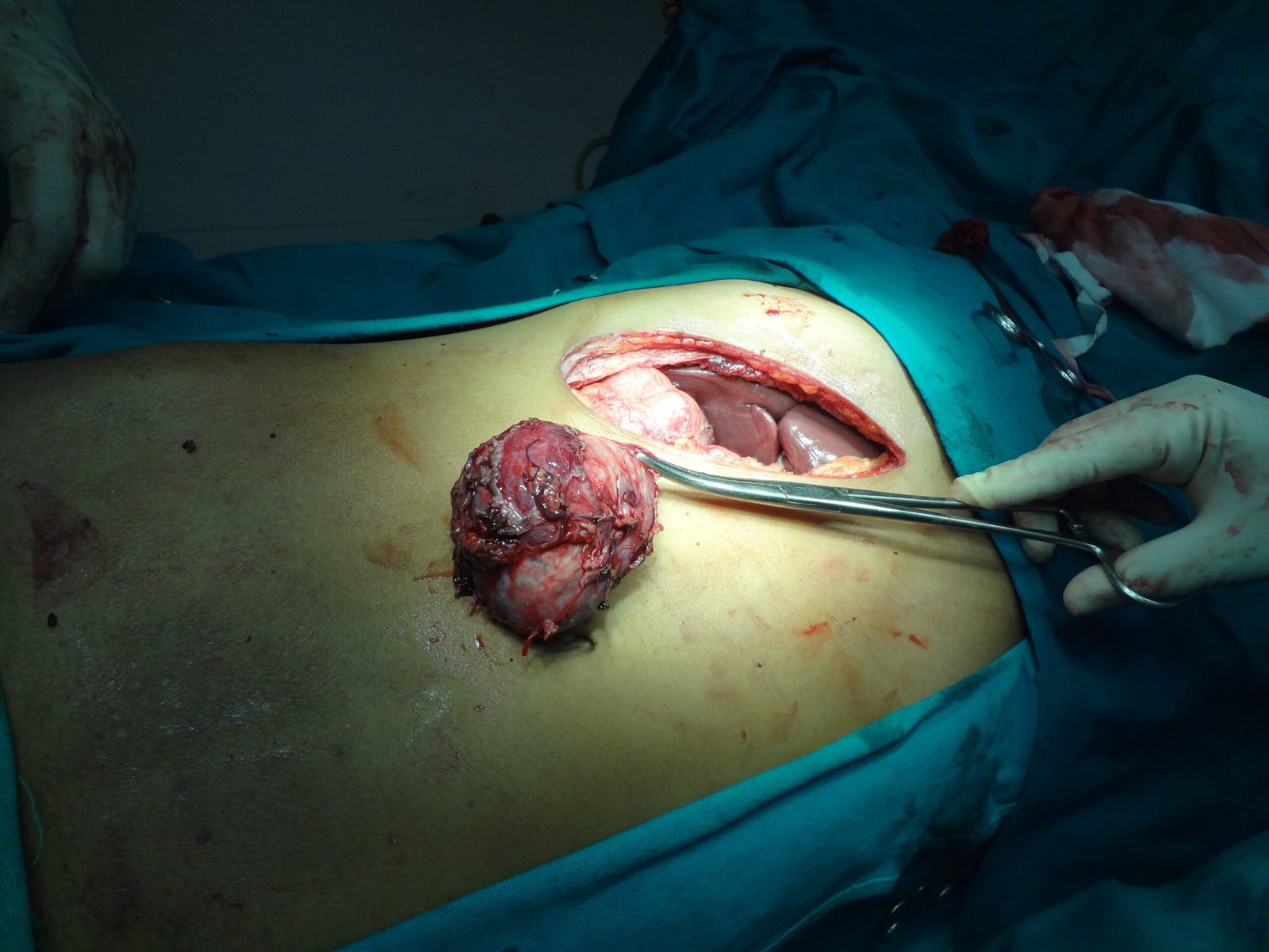 adrenal tumor for gallary 2