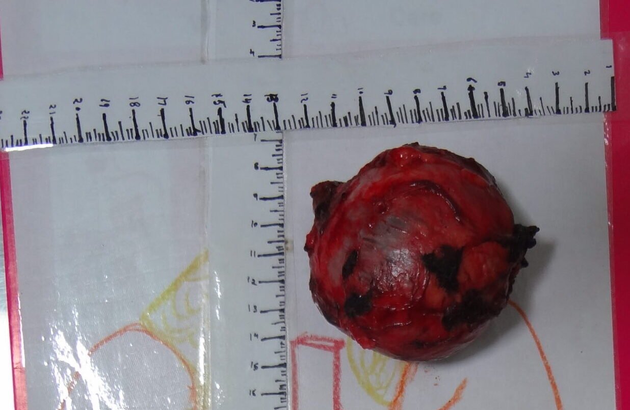 adrenal tumor for gallary2