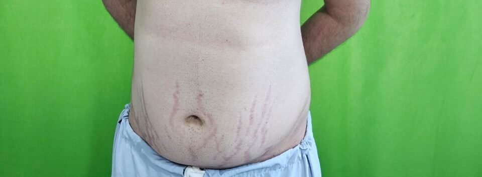 cushing_s features1(2)