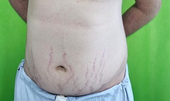 cushing_s features1(2)