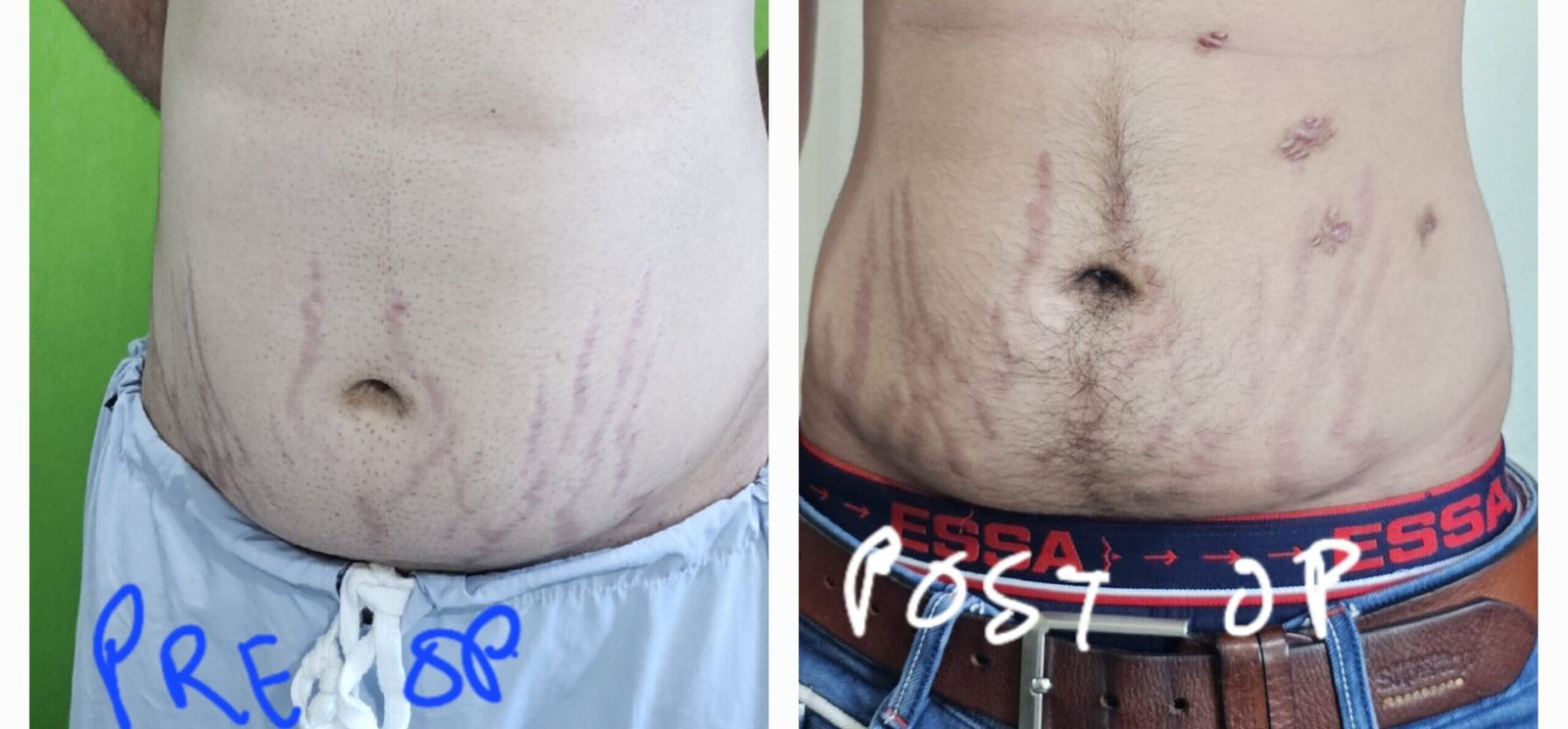 cushing_s features1(5)