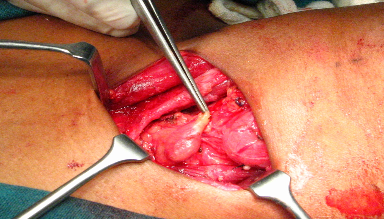 intra-operative view of parathyroid tumor- for gallary