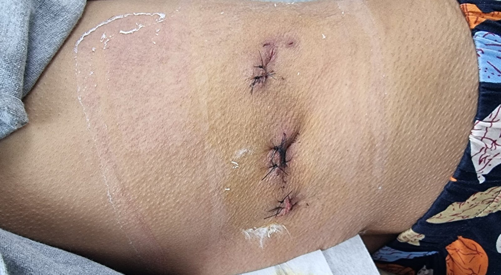 retroperitoneoscopi adrenalectomy