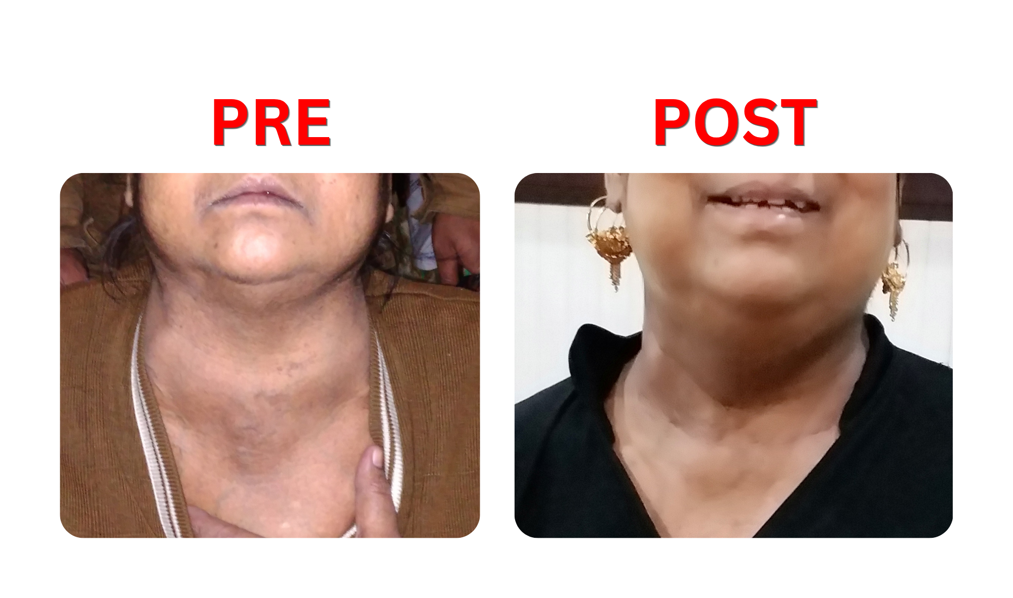 Thyroid
