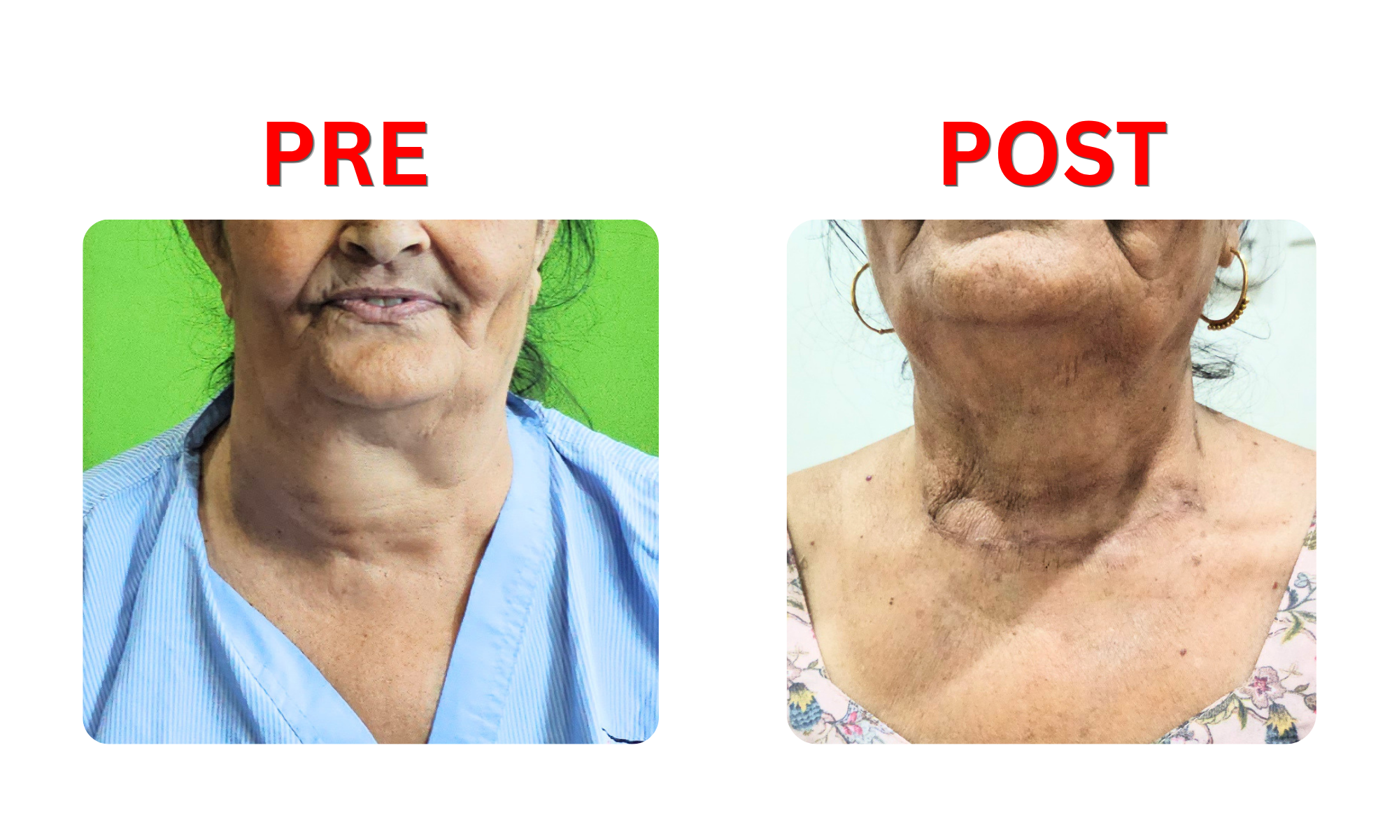 prpo