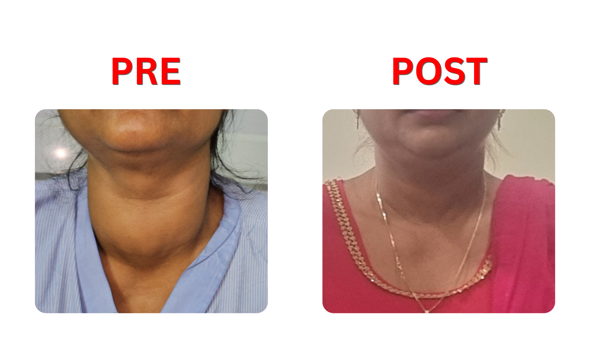 ttx pre-post